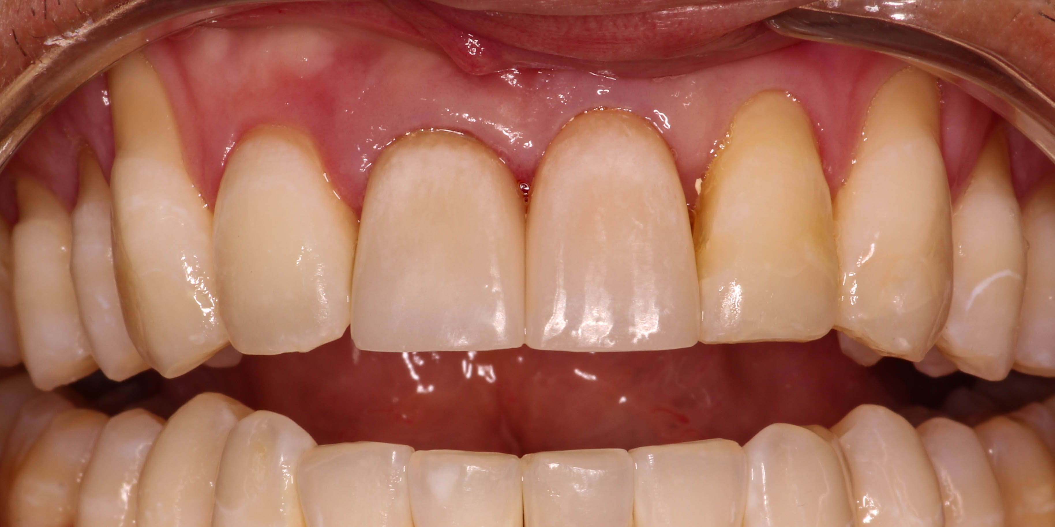 Restored front tooth after emergency treatment