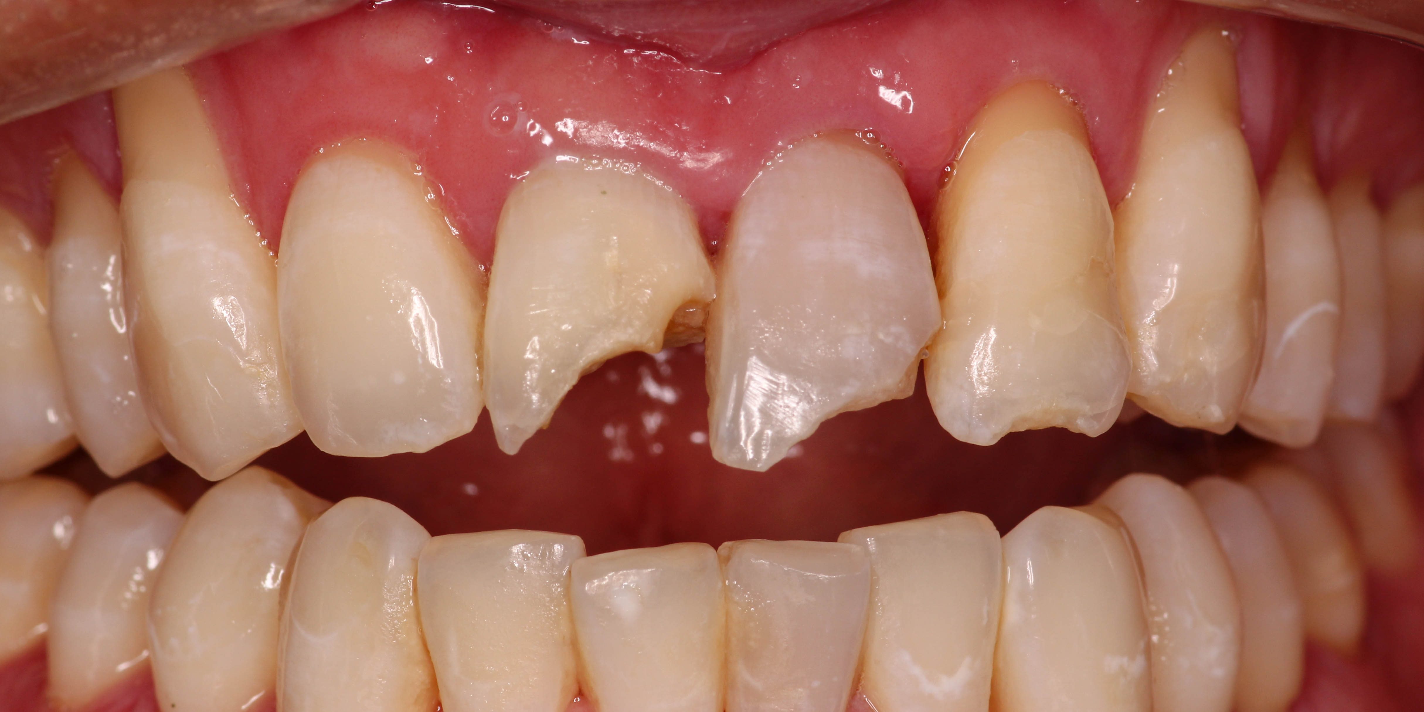 Broken front tooth before emergency treatment